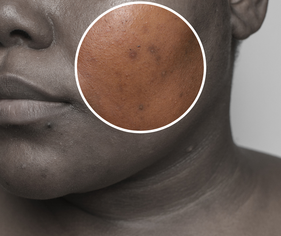 How to Fade Dark Spots & Hyperpigmentation